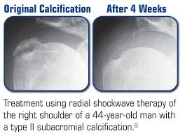 Shockwave Therapy West Midlands reduces spur