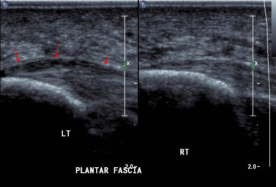 Diagnostic Ultrasound of the Plantar Fascia Ligament
